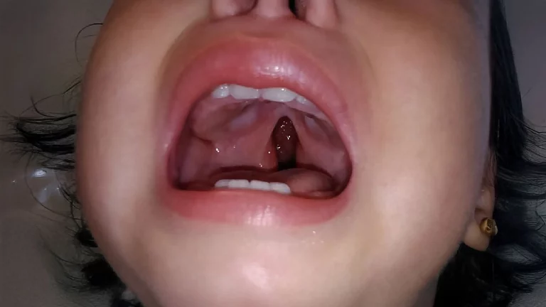 mitos-paladar-hendido