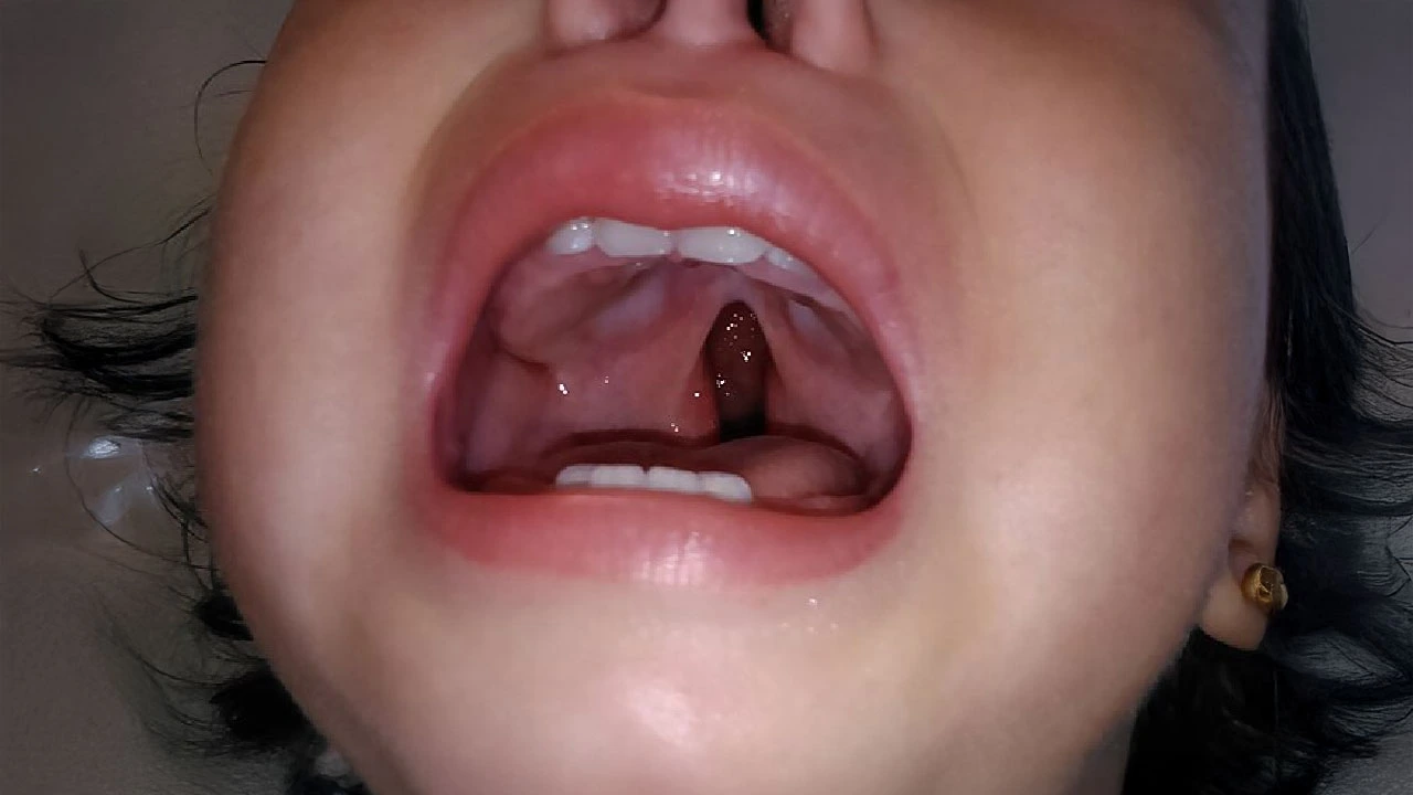 mitos-paladar-hendido